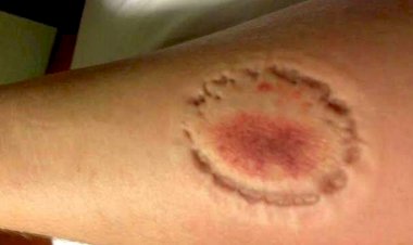 Apenado com tornozeleira desligada morde policial e ameaça agentes durante abordagem em Vilhena