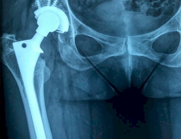 Governo de Rondônia amplia acesso a cirurgias de quadril com incentivo financeiro estadual